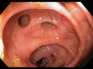 diverticulosis